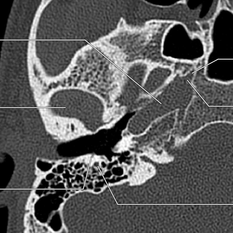 Image shows descending mastoid segment & posterior canaliculus of the chorda tympani nerve. Note GSPN forming the vidian nerve at the foramen lacerum.