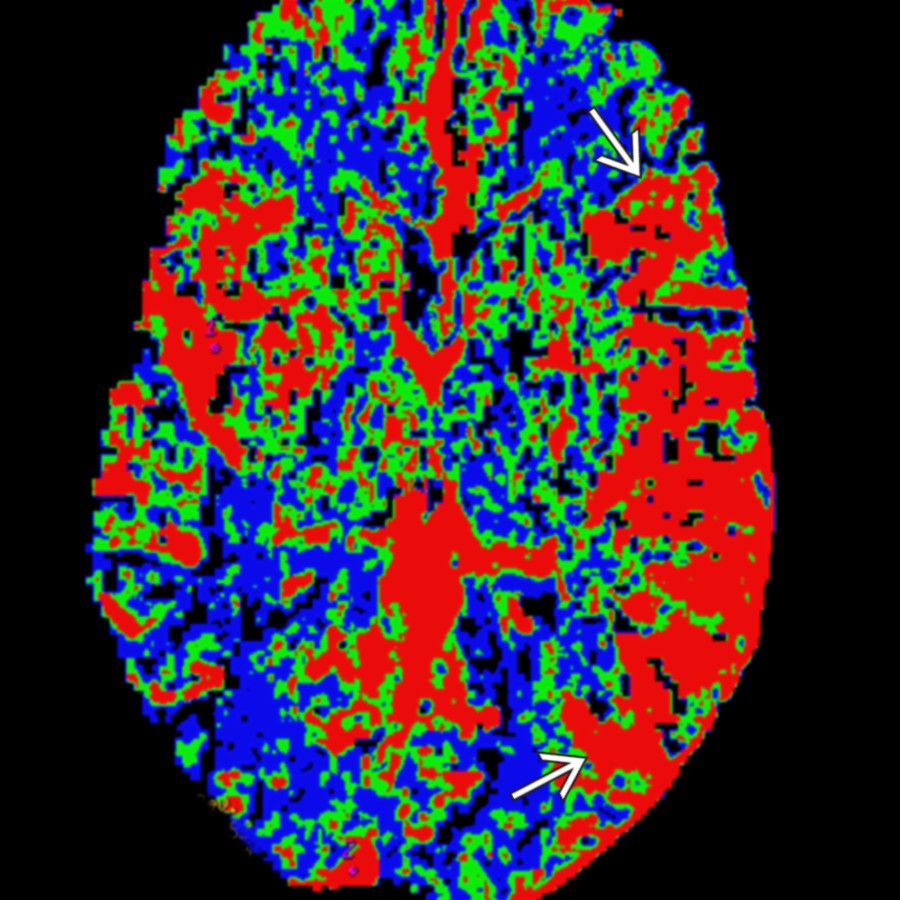 Following restoration of normal blood flow in the previously occluded left MCA, the patient experienced worsening right-sided weakness and throbbing headache. Axial MR perfusion study shows elevated (red area ), not decreased, CBF in the left temporal and parietal lobes.