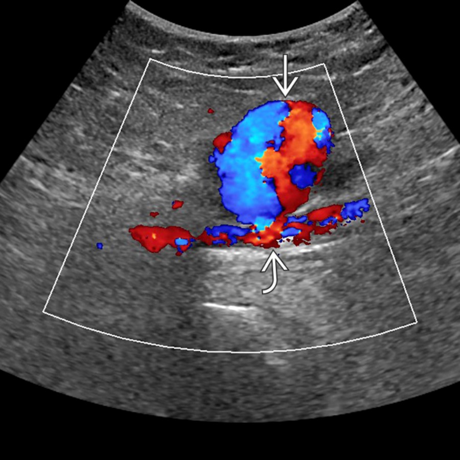 Color Doppler US in a patient who had undergone recent groin catheterization shows the characteristic features of a pseudoaneurysm  with a yin-yang pattern of internal color flow. Note that the pseudoaneurysm does appear to connect with the adjacent femoral artery .