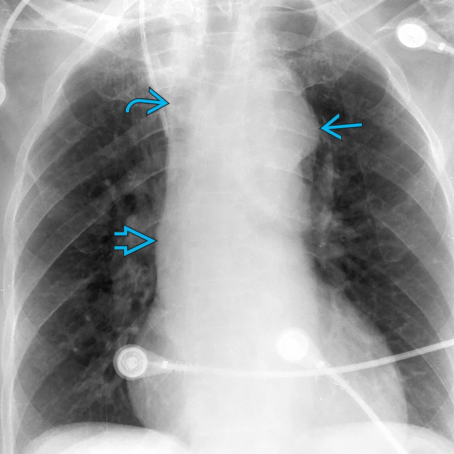PA chest radiograph shows dilation of the thoracic aorta, evidenced by abnormal contour of the aortic arch  and displacement of the intrathoracic trachea to the right . The ascending aorta  is visible overlying the right hilum.