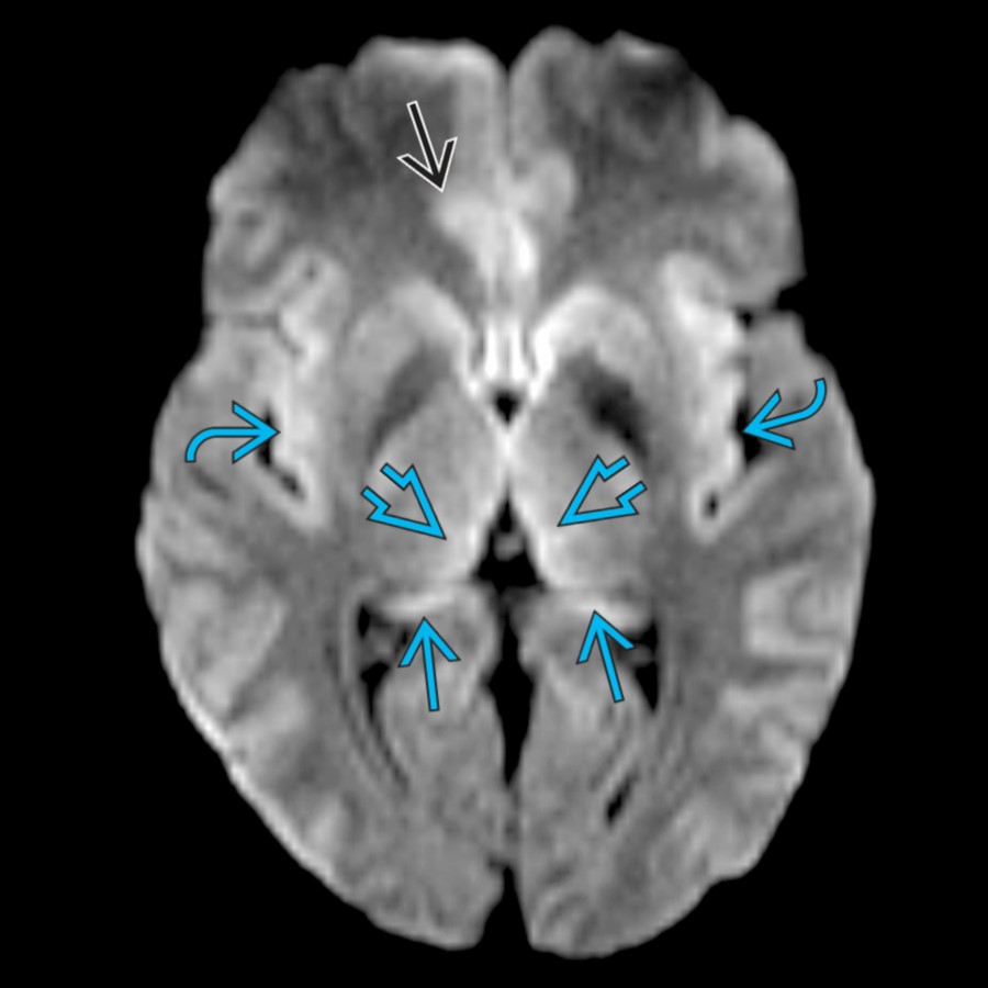 Axial b=1000 DWI MR shows increased signal in the tail of the hippocampi , medial thalami , insular cortex , and cingulate cortex  in a patient with hyperammonemia from hepatic encephalopathy.