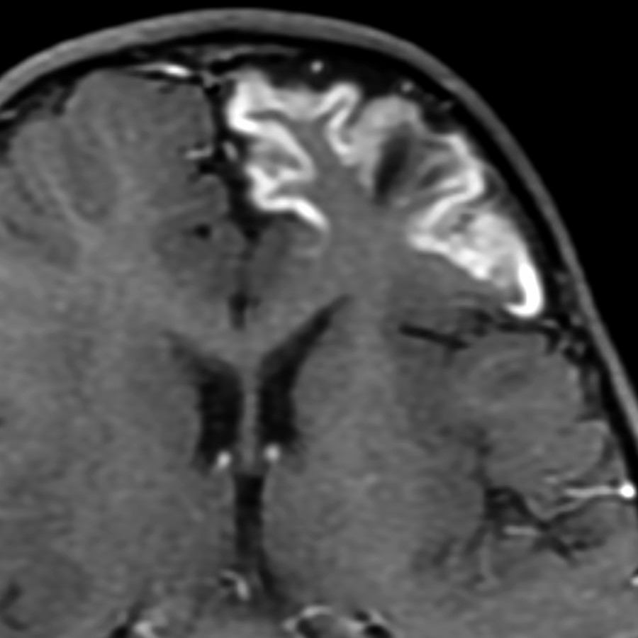 Axial T1 C+ MR in a 1 year old with arteriopathy & subacute infarction shows gyriform enhancement of the cortical ribbon. Enhancement is common in the subacute phase of infarction. Precontrast T1 is necessary to distinguish true enhancement from the intrinsic ↑ T1 seen in cortical laminar necrosis.