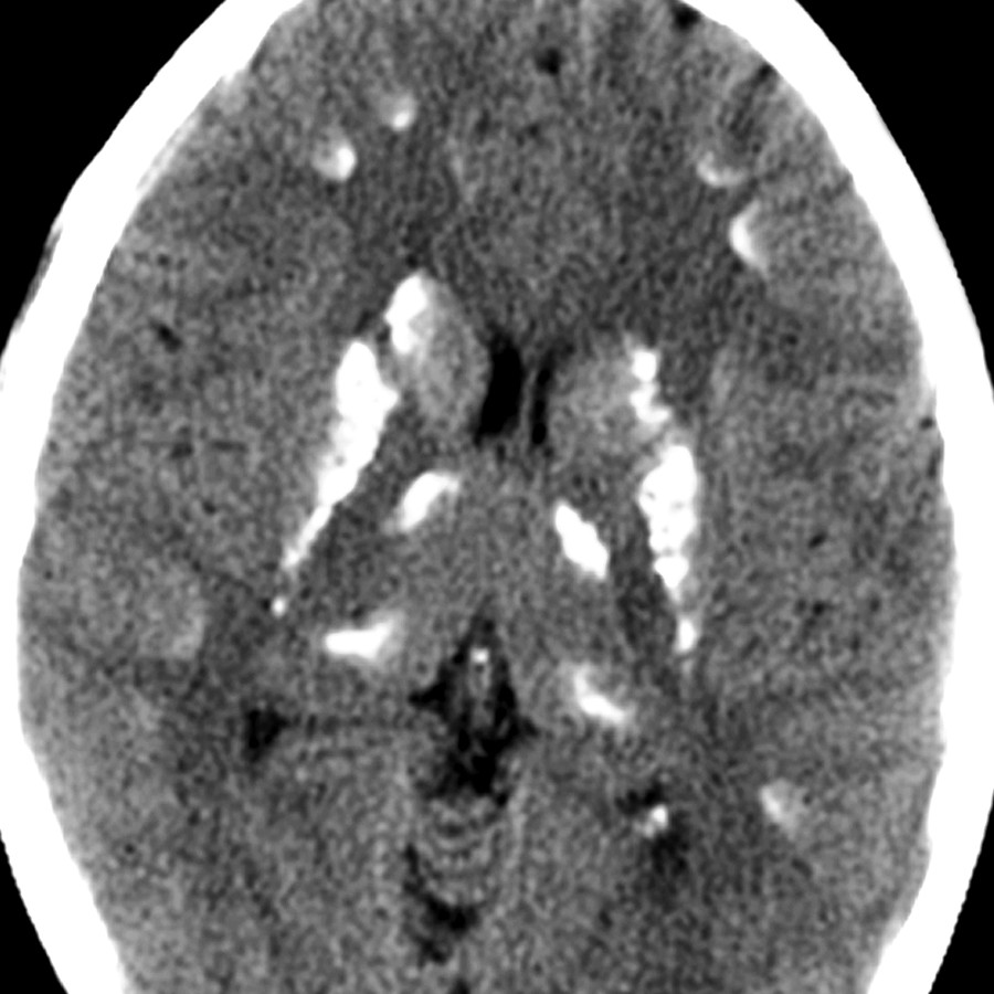 Axial NECT shows the typical CT appearance of Fahr disease (FD) with extensive calcifications present in the BG, cerebral white matter (WM), & at the subcortical gray matter-WM junctions.