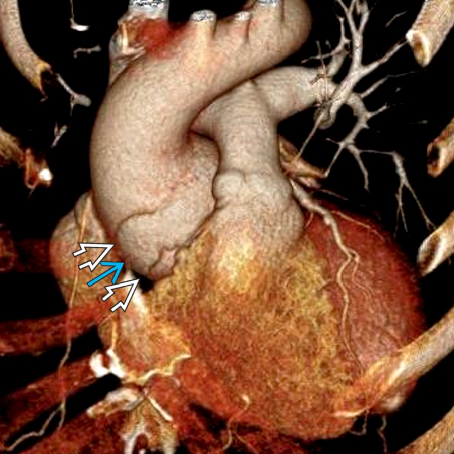 External view of the semicircumferential LIT shows a band or stripe of bulging tissue in the ascending aorta  with sharp,  undermined edges .