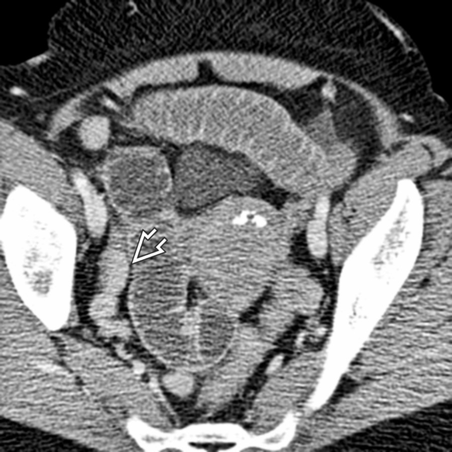 Axial CECT shows an incarcerated femoral hernia in the femoral canal. Note the decompressed distal small bowel, suggesting a small bowel obstruction .