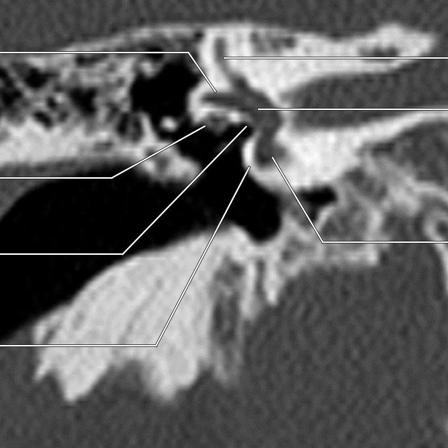 CT shows characteristic craniocaudal orientation of the LSCC, facial nerve canal (tympanic segment), oval window, & cochlear promontory. Superior & LSCCs, vestibule, & basal turn of cochlea together form a goose/duck-like appearance. Focal dehiscence of undersurface of tympanic segment facial nerve canal is a normal variant occurring in as many as 20-25% of adults, most commonly just above oval window, but is important to mention in presurgical temporal bone CT reports to avoid nerve injury during middle ear surgery.