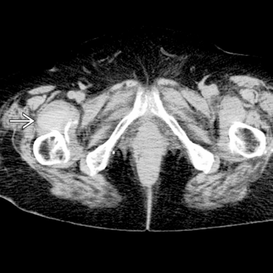 Axial NECT shows a heterogeneous, high-attenuation mass  deep to the femoral vessels and superficial to the femur. This was found to be groin hematoma.