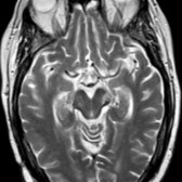 Axial T2WI MR in the same patient shows cerebral peduncle hyperintensity  due to CST WaD from the tumor. There is slight volume loss with linear T2 hypointensity along the posterolateral margin .