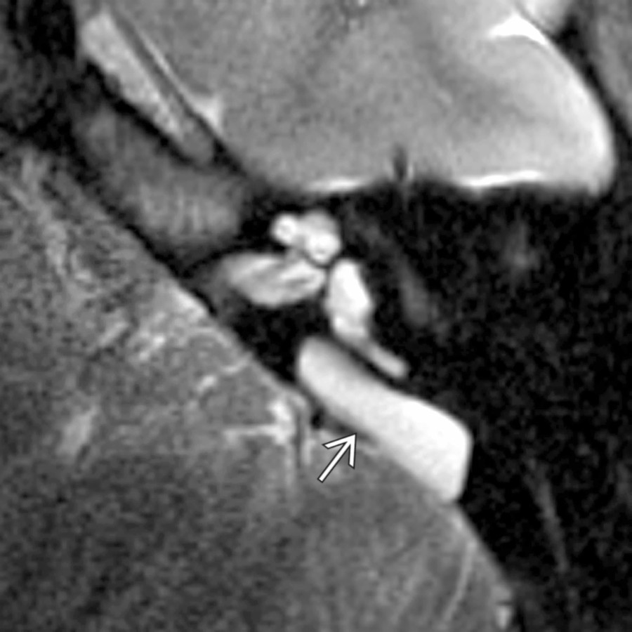 Axial T2WI MR shows a large endolymphatic sac  within the posterior wall of the temporal bone. CT (not shown) would reveal a large bony vestibular aqueduct in this patient with large endolymphatic sac anomaly.