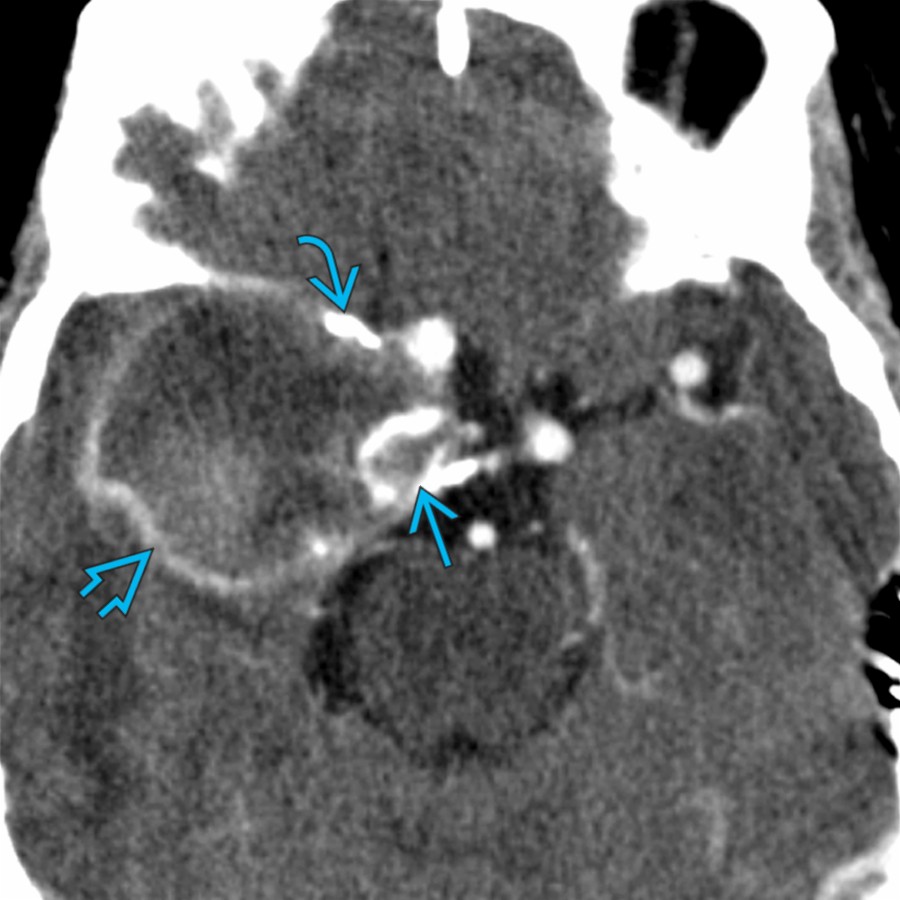 Axial CECT shows a giant, mostly thrombosed, saccular aneurysm. Note the ring enhancement  of the thrombosed segment of the aneurysm as well as globular  and rim  calcification. CTA or MRA is key for making an accurate preoperative diagnosis.