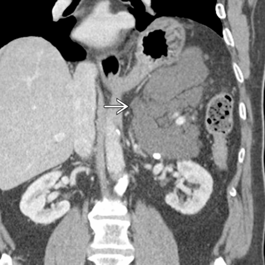 Coronal CECT in the same patient nicely demonstrates the multiloculated, feathery morphology of the lesion . This appearance is quite common with lymphangiomas, which frequently appear to have multiple internal discrete components or locules.