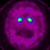 Axial I-123 ioflupane SPECT shows absent bilateral putamen activity  and preserved caudate activity . These finding are consistent with PD or APS.