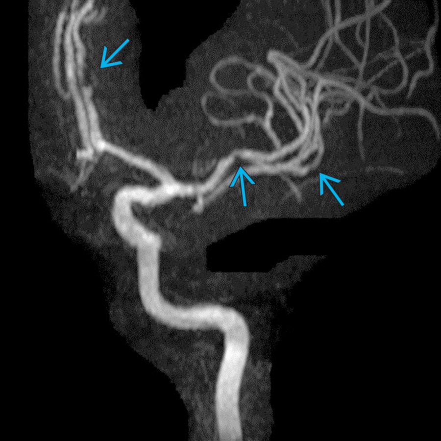 MIP MRA shows multifocal stenoses , characteristic for intracranial atherosclerosis, the most common cause of alternating stenoses and dilatations. Risk factors include diabetes, hypertension, hyperlipidemia, and smoking.