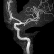MIP MRA shows multifocal stenoses , characteristic for intracranial atherosclerosis, the most common cause of alternating stenoses and dilatations. Risk factors include diabetes, hypertension, hyperlipidemia, and smoking.