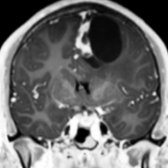 Coronal T1 C+ MR shows a cyst and a solid enhancing, cortically based mass with a broad dural base . The broad dural base of this cortically based intraaxial tumor is a typical appearance for pleomorphic xanthoastrocytoma.