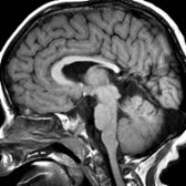 Sagittal T1 MR shows a small pituitary gland  and absent pituitary stalk. The hyperintense ectopic posterior pituitary gland  is located at the median eminence. The corpus callosum is also dysmorphic with characteristic small splenium .