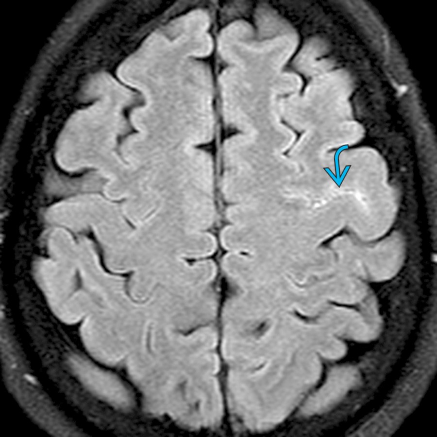 Axial FLAIR MR in a patient with acute cortical subarachnoid hemorrhage due to cortical venous thrombosis shows high signal   in the left frontal sulci.