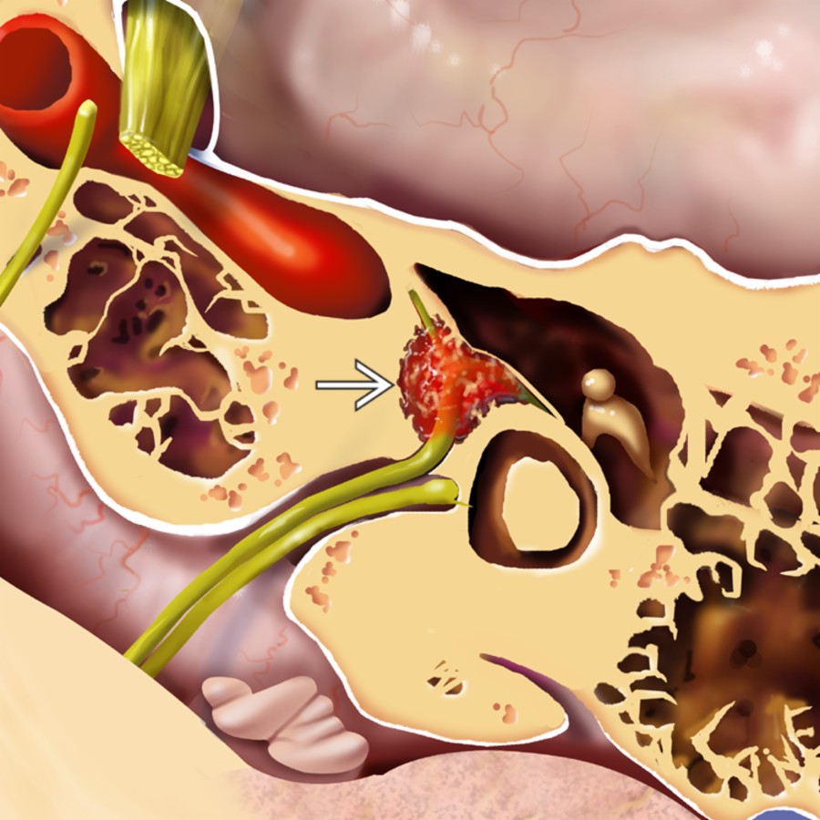 Axial graphic illustrates a classic example of a medium-sized facial nerve venous malformation (FNVM) centered in the geniculate fossa  of the temporal bone. Notice the honeycomb bone within the lesion matrix.