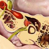 Axial graphic illustrates a classic example of a medium-sized facial nerve venous malformation (FNVM) centered in the geniculate fossa  of the temporal bone. Notice the honeycomb bone within the lesion matrix.