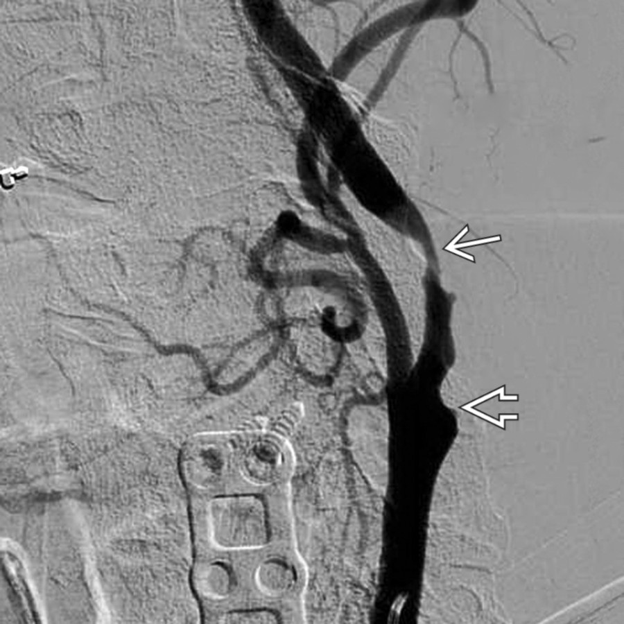 Lateral DSA (same patient) demonstrates similar findings compared with CTA: Ulceration and narrowing at the internal carotid artery origin  and more distal high-grade stenosis .