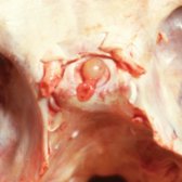 Axial gross pathology shows a mucinous-containing Rathke cleft cyst  found incidentally at autopsy. (Courtesy E. Hedley-Whyte, MD.)