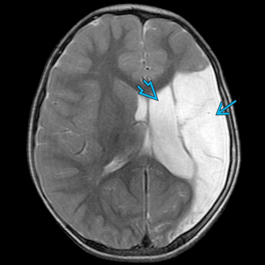 Axial T2 MR in the same patient 2 years later shows cystic encephalomalacia  throughout left MCA territory & passive enlargement of the left lateral ventricle . Patients with PAIS who do not present near birth with seizures may later present with early hand preference or extremity weakness.