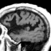 Sagittal T1WI MR in a 72-year-old patient with suspected AD shows marked enlargement of the sylvian fissure  compared to the other subarachnoid spaces. Cortical atrophy of structures around the sylvian fissures can be striking, as in this case.