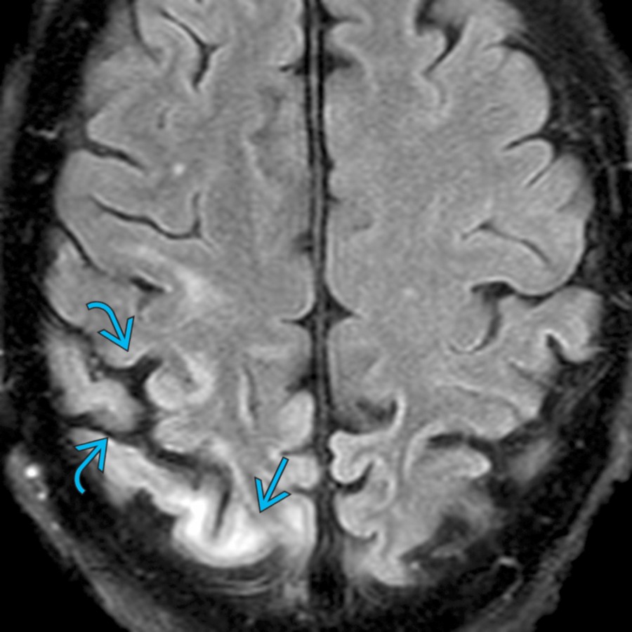 Axial FLAIR MR in the same patient on day 25 shows prominence of the sulci    due to cortical volume loss. Note subcortical white matter hyperintensity    due to gliosis.