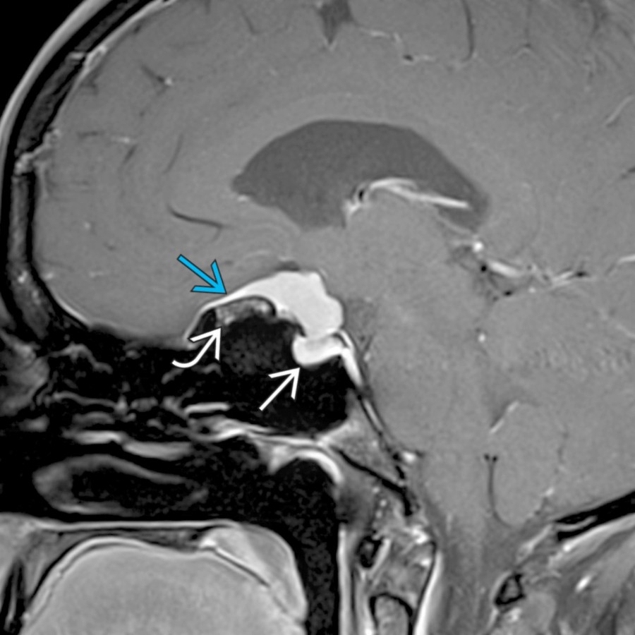 Sagittal T1 C+ FS MR shows an enhancing suprasellar meningioma with a dural tail  along the planum sphenoidale and hyperostosis of the adjacent bone . Note the separate pituitary gland is seen inferiorly within the normal-sized sella turcica .