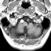 Axial T1WI MR shows an enlarged right vertebral artery with high signal intensity  as well as an absent flow void of the left vertebral artery .