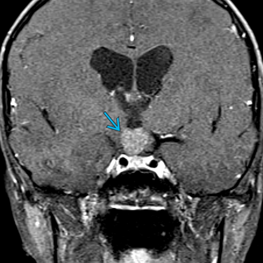 Coronal T1 C+ FS MR shows a lobular,  enhancing mass  centered in the hypothalamus and pituitary stalk. This was a germinoma at surgery. Suprasellar and pineal midline locations are the most common location for intracranial germinomas.