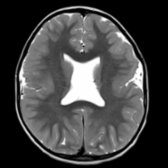 Axial T2 MR in septo-optic dysplasia plus shows bilateral perisylvian polymicrogyria , absent septum pellucidum , & optic nerve hypoplasia. Note extensive areas of irregular cortical thickening with shallow sulci & irregular GM-WM junction.