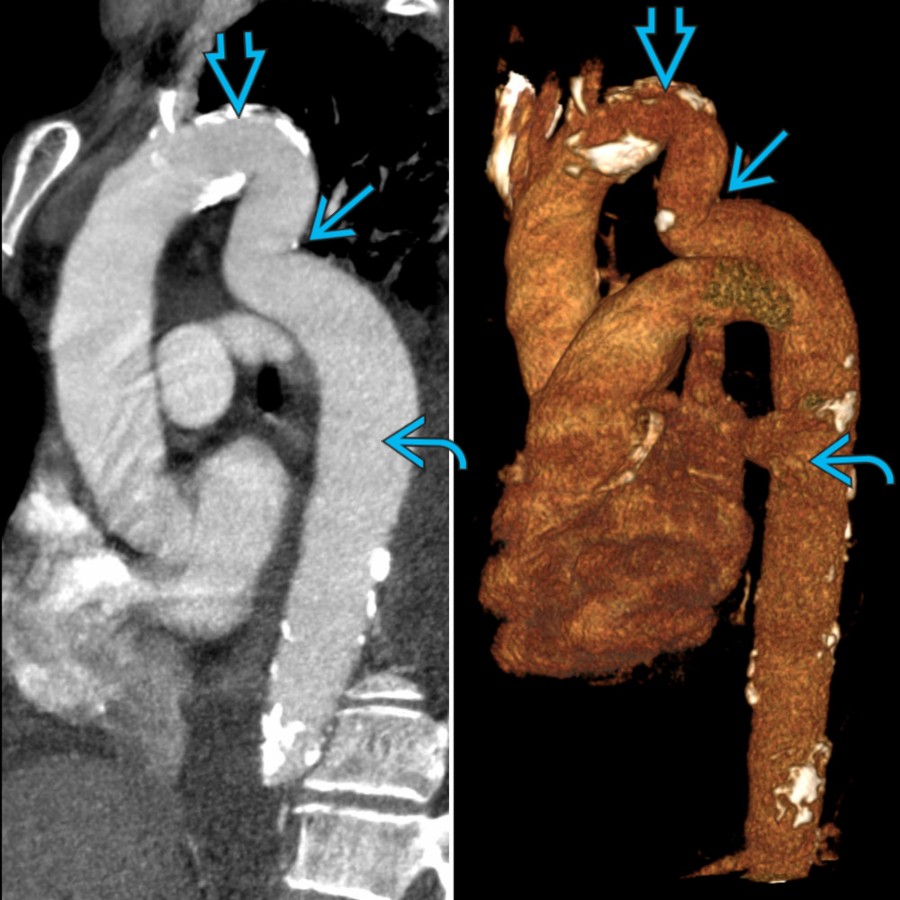 MIP (left) and volume-rendered (right) images in the same patient show aortic PCOA with elongation and superior extension of the proximal DTA , which then extends inferiorly with kinking  before taking its normal course .
