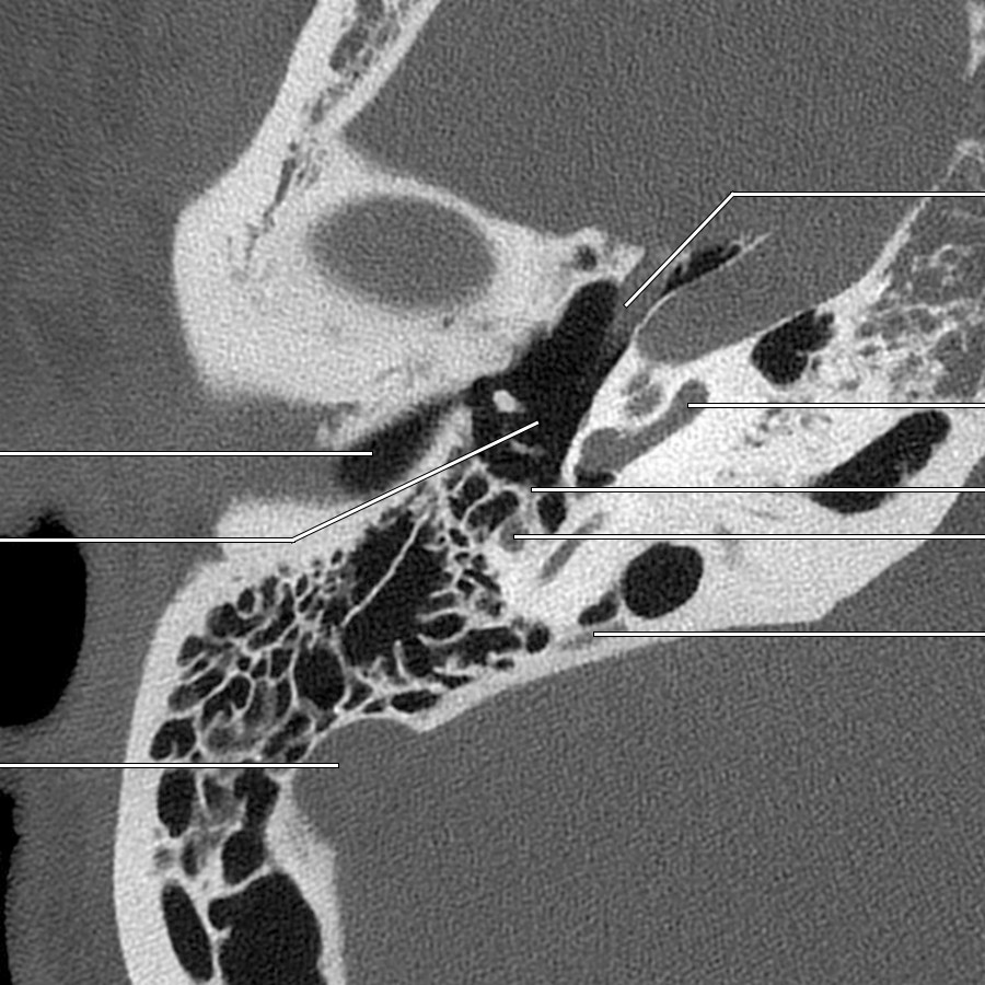 This image demonstrates the high mastoid segment of CNVII canal posteriorly, which then descends toward the stylomastoid foramen. Nerve to stapedius arises at this level.