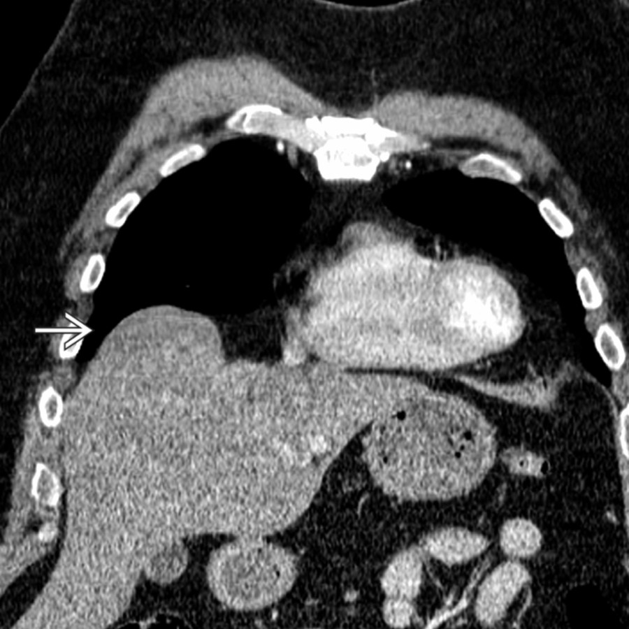 Coronal CECT shows the characteristic appearance of diaphragmatic eventration with focal scalloping of the right anterior hemidiaphragm and superior protrusion of the liver at the site of eventration .