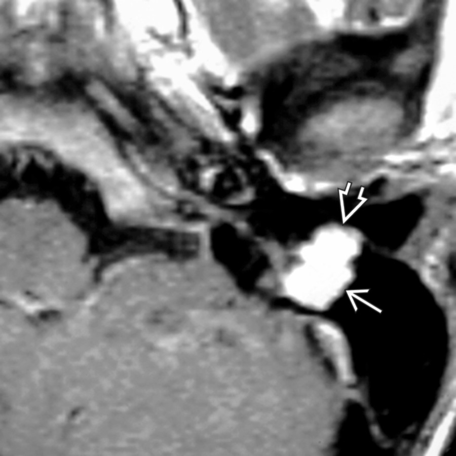 Axial T1 C+ MR demonstrates a mastoid segment facial nerve schwannoma . Notice that the enhancing tumor has dehisced the posterior wall of the external auditory canal .