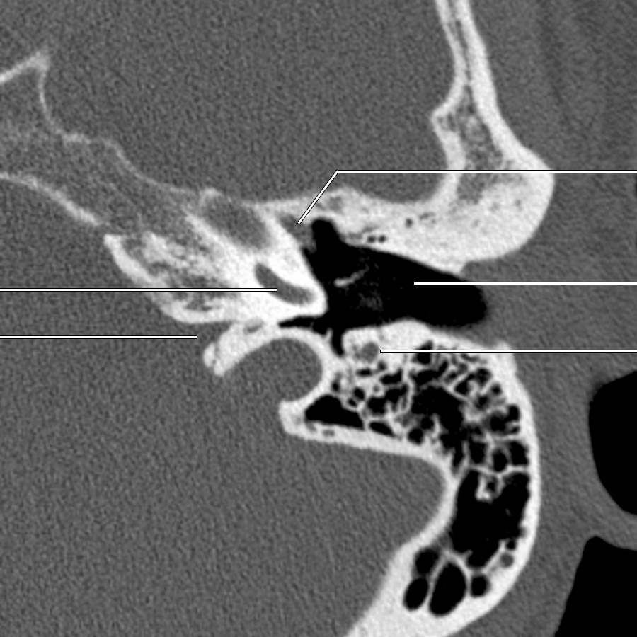 At the level of the basal turn of the cochlea, the mastoid segment of the facial nerve is still visible. Both the nerve to the stapedius muscle proximally and the chorda tympani distally branch off the mastoid segment (CNVII).