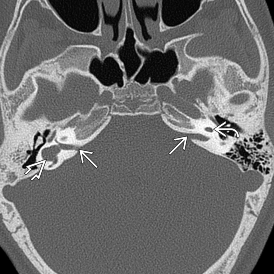 Axial bone CT in a 10-year-old girl with SNHL shows small IACs  and a globular right vestibule and horizontal SCC . The right cochlea (not shown) lacked internal septation (IP-I). A hypoplastic, isolated left cochlea     is also seen.