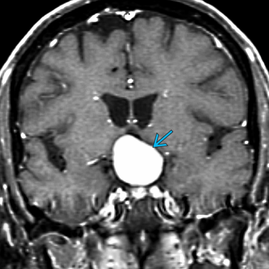 Coronal T1 C+ MR in the same patient shows strong uniform enhancement  of this large pituicytoma. Such enhancement is typical of these rare tumors of the neurohypophysis or infundibulum. These vascular tumors are WHO grade 1. (Courtesy A.V. Hasso, MD.)