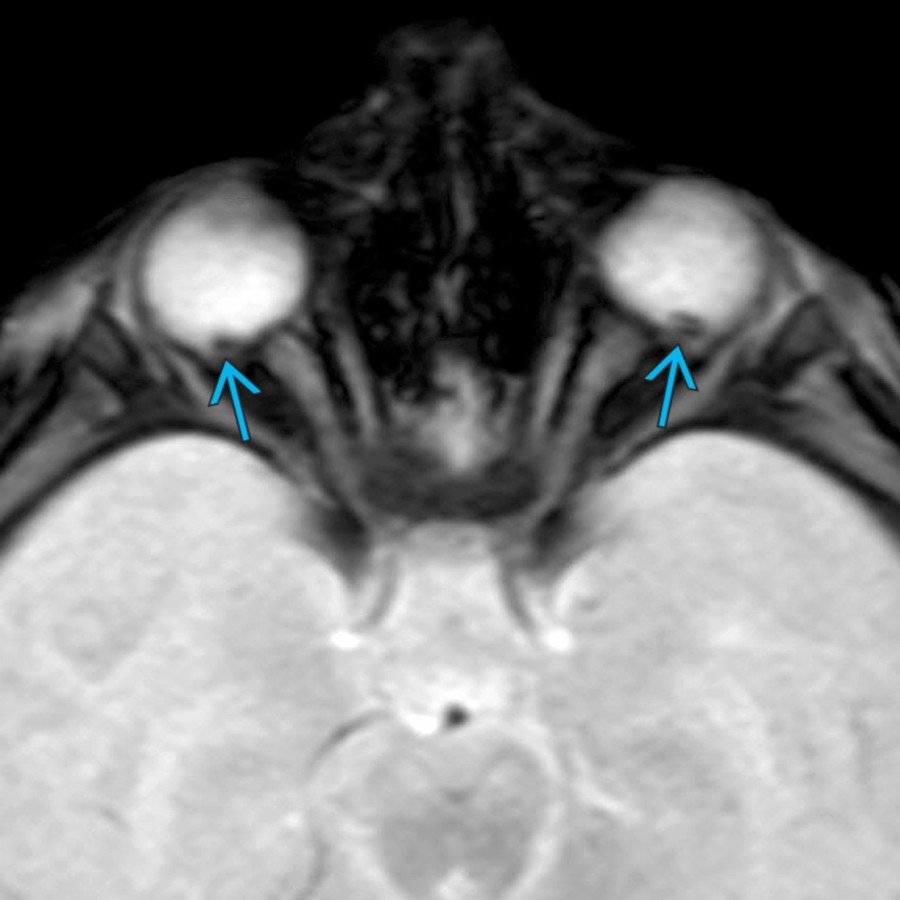 Axial T2 SWI MR in a 4-month-old with AHT shows bilateral retinal hemorrhages . Although SWI is the most sensitive imaging sequence for retinal hemorrhages, it is insensitive relative to a funduscopic exam. A normal MR appearance of the globes does not exclude retinal hemorrhages.
