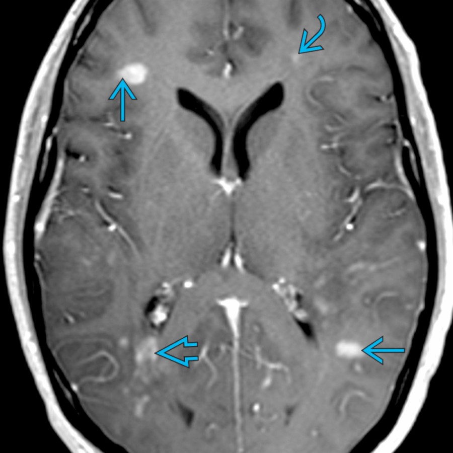 Axial T1 C+ MR demonstrates multiple lesions with nodular, broken ring, and curvilinear enhancement in juxtacortical , deep  and periventricular  white matter (WM), consistent with active demyelinating lesions in a patient with multiple sclerosis.
