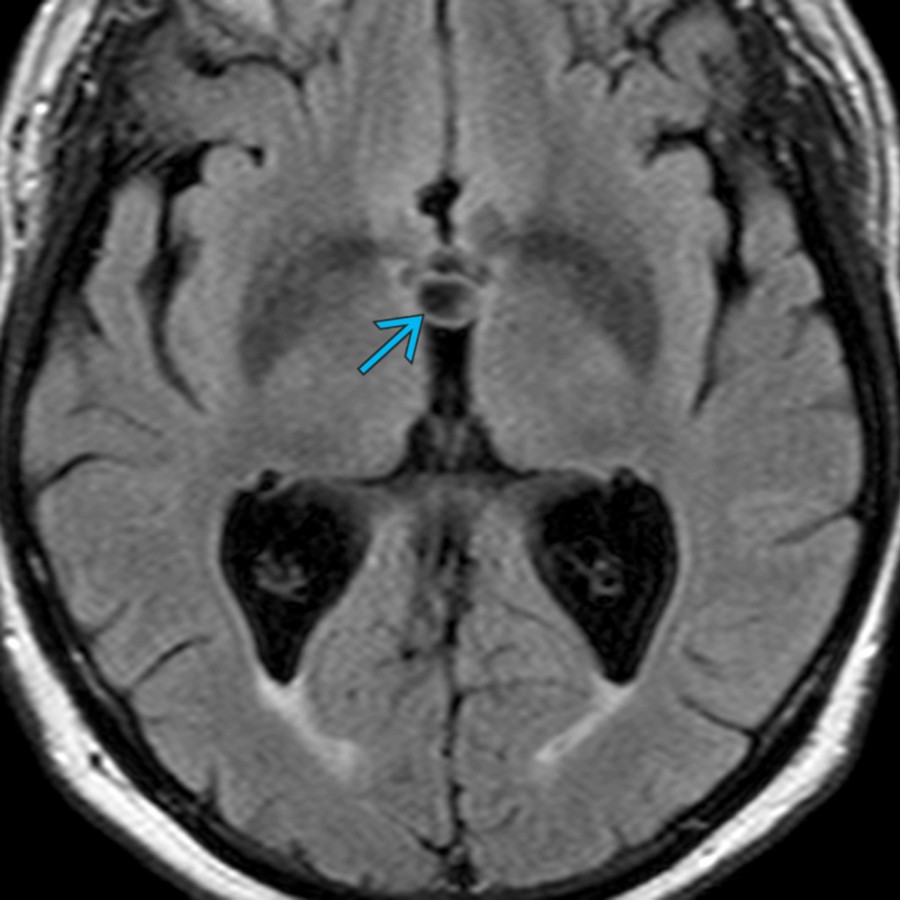 Axial FLAIR MR in a 65 year old with a "thunderclap" headache shows a foramen of Monro mass   that is a colloid cyst. Other than CSF flow artifact, colloid cysts are the most common lesion found in this location. They are common in adults but relatively rare in children.