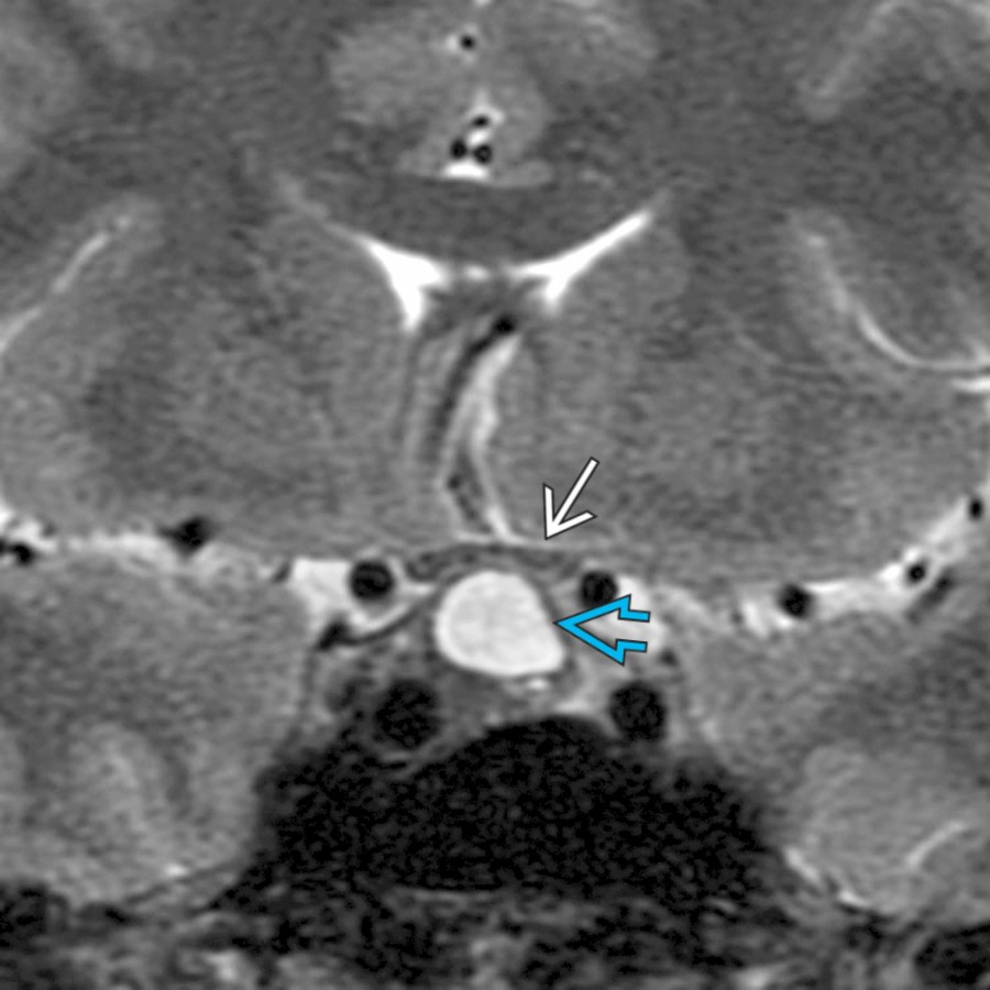 Coronal T2 MR shows a cystic macroadenoma  with mild mass effect on the left optic chiasm  in a 41-year-old with elevated growth hormone.