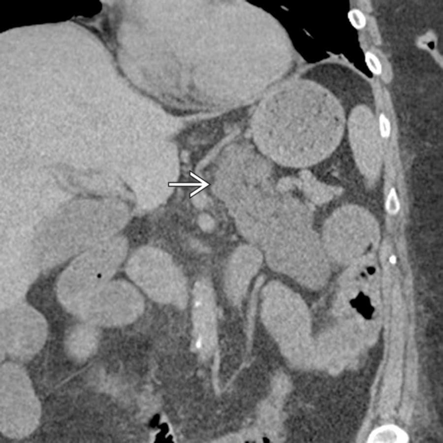 Coronal NECT demonstrates the classic appearance of an incidental lymphangioma  . Notice the feathery, multiloculated appearance of the lesion with multiple small internal compartments.