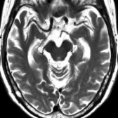 Axial T2WI MR in the same patient exhibits mild atrophy of the medial temporal lobes.