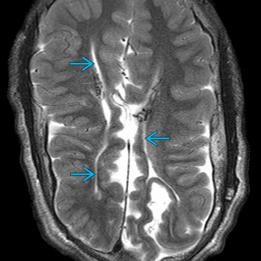 Axial T2 MR in a patient with chronic shunting demonstrates slit-like irregular lateral ventricles  due to noncompliance from chronic drainage.