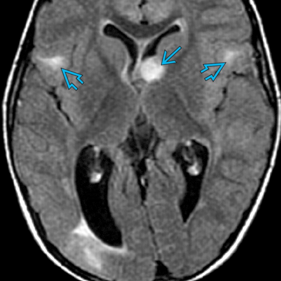 Axial FLAIR MR in a 3 year old with seizures shows a hyperintense mass  at the interventricular foramen. Note the flame-shaped subcortical hyperintensities . This is tuberous sclerosis with a subependymal giant cell astrocytoma.