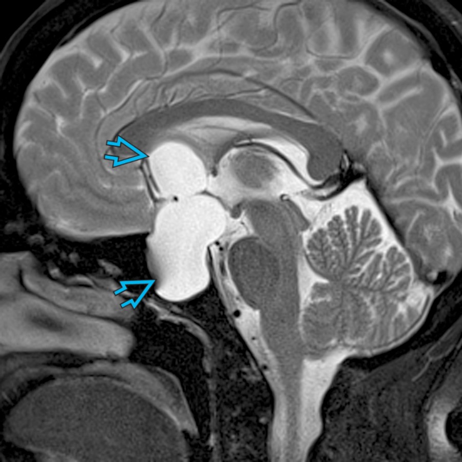 Sagittal T2WI MR shows a cystic sellar and suprasellar mass  related to an arachnoid cyst (AC). These benign lesions follow CSF on all MR sequences and do not enhance. The normal pituitary gland is usually thinned and wrapped anteriorly around the AC.