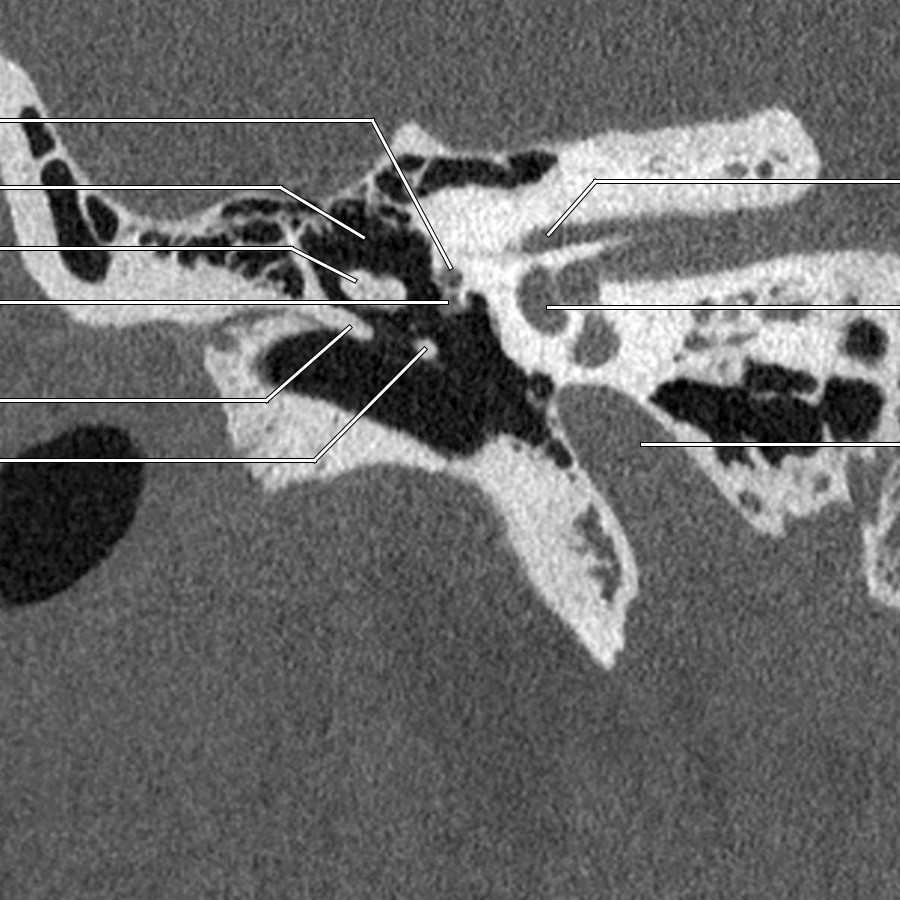 First of 6 coronal reformatted high-resolution NECT bone window images show the labyrinthine segment of CNVII canal arising from the superior aspect of the fundus of the IAC.