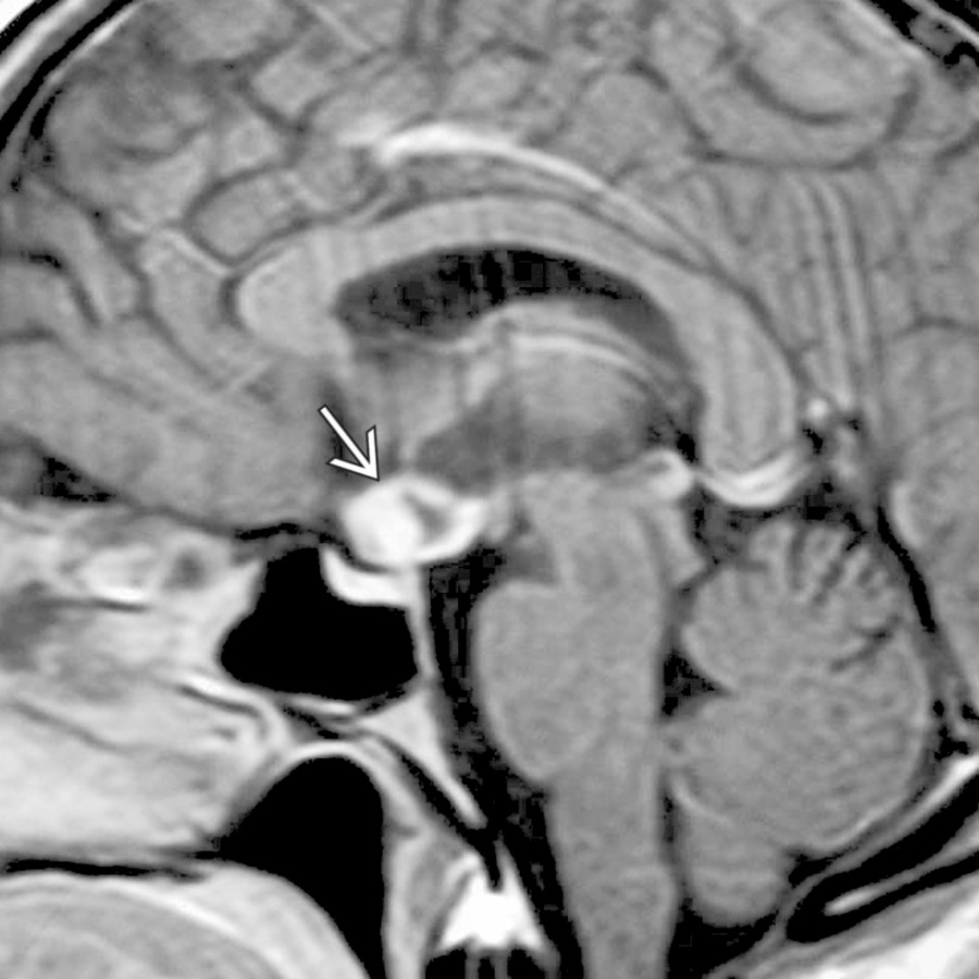 Sagittal T1 C+ MR shows an inhomogeneously enhancing mass in the anterior 3rd ventricle, hypothalamus .